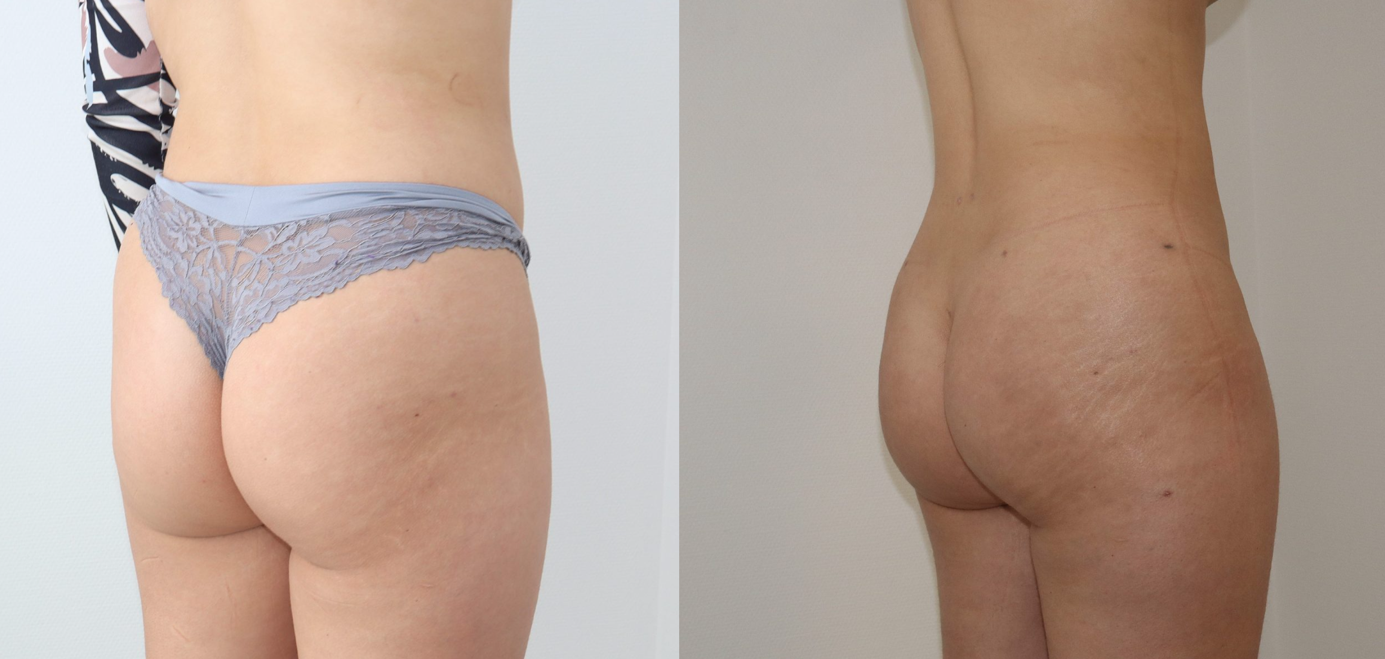 Avant/Après chirurgie des fesses